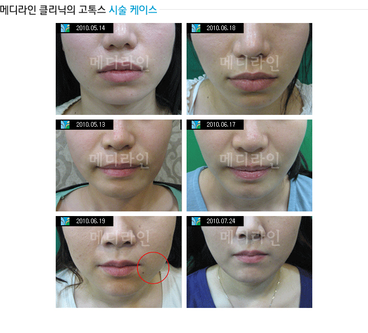 메디라인클리닉의 고톡스 시술케이스